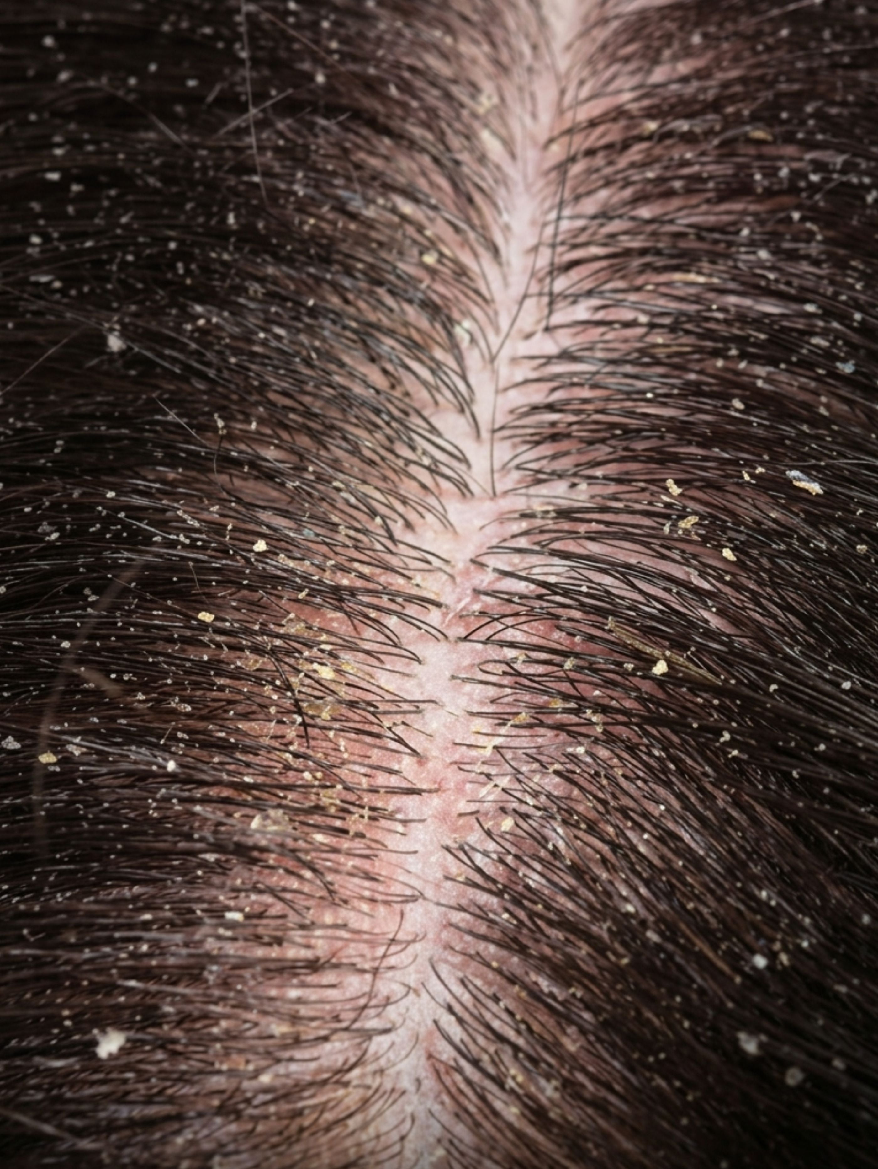 Dermite séborrhéique du cuir chevelu: un déséquilibre à accompagner avec précision.